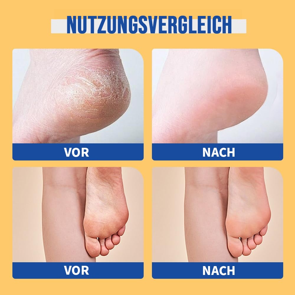 🔥LETZTER TAG 49 % RABATT & Feuchtigkeitsspendende und rissfreie Fußcreme